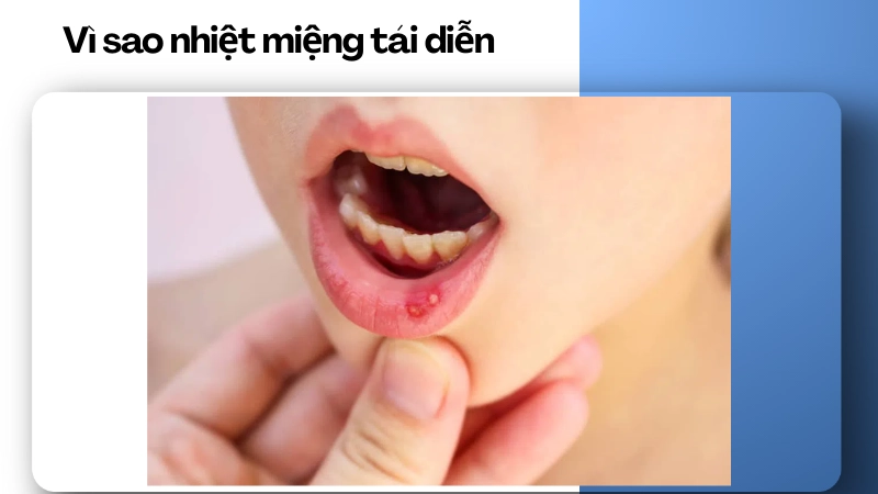 Lý do nhiệt miệng tái phát liên tục