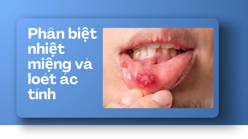 Phân biệt nhiệt miệng và loét nguy hiểm