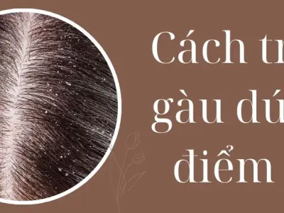 Cách trị gàu dứt điểm bằng nguyên liệu tự nhiên tại nhà