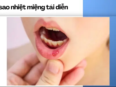 Nhiệt miệng dai dẳng- Đừng lơ là khi cơ thể đang kêu cứu